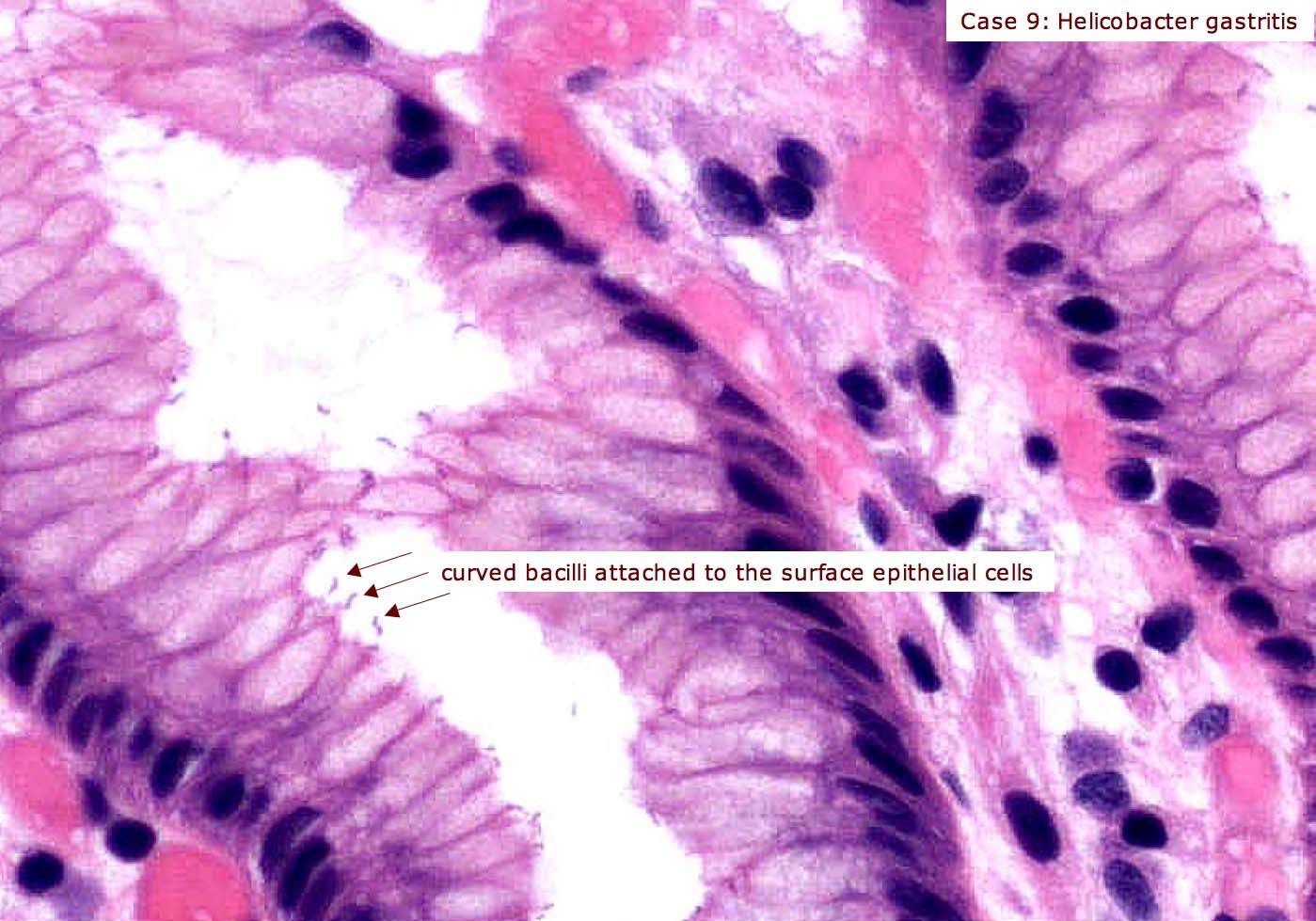 Visual appearance of H. pylori on an H&E slide (source)