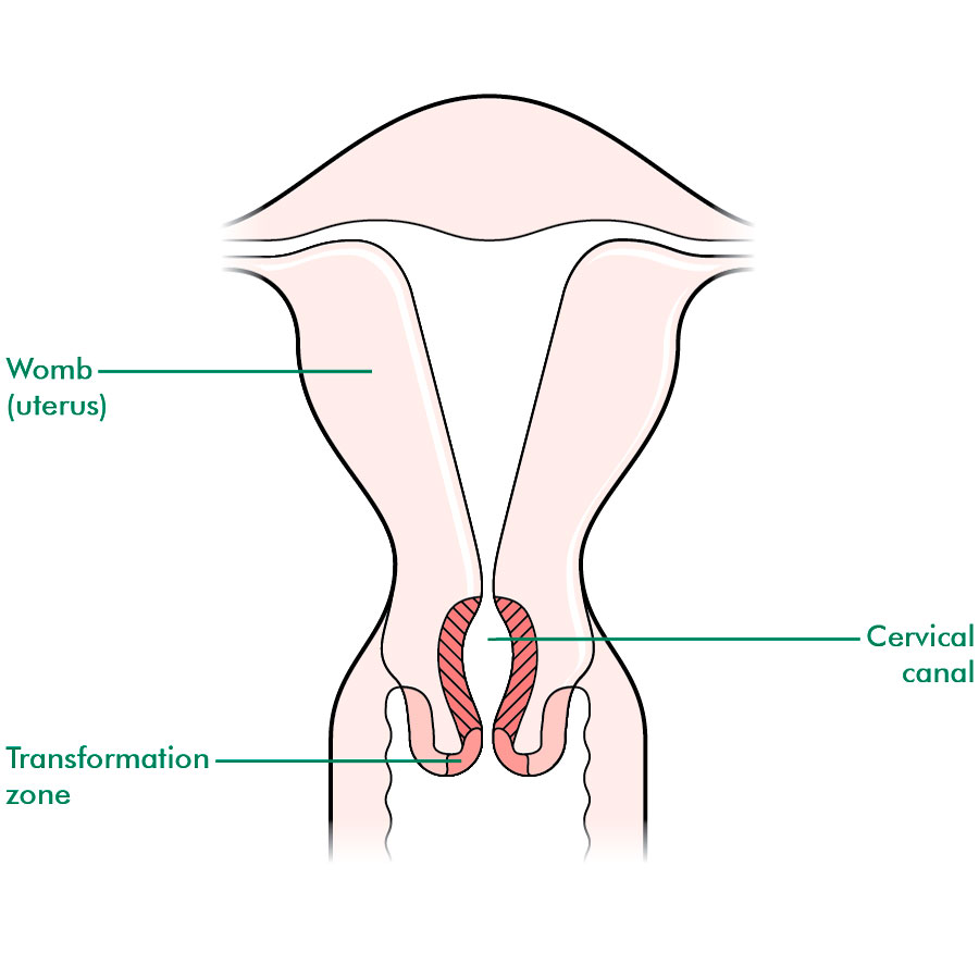 Anatomical location of the transformation zone. This is the most common site of cervical cancer (source) 
