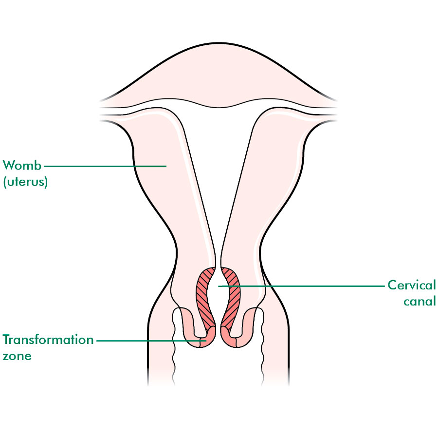 Anatomical location of the transformation zone. This is the most common site of cervical cancer (source)