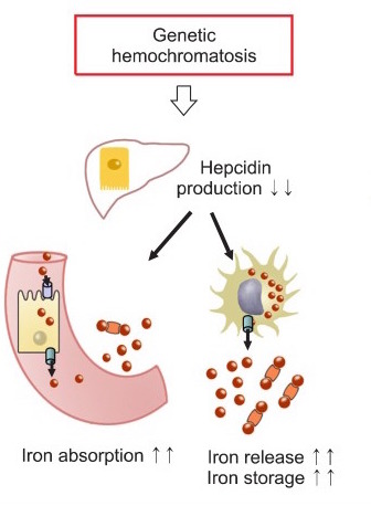 hemochromatosis gene