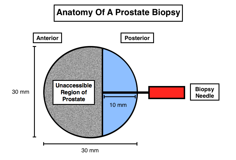 The anterior 2/3rds of the prostate are not accessible by the needle used for biopsy, and more aggressive forms of cancer can be found in this anterior region of the prostate (source) 