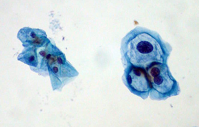 Normal (left) vs. abnormal/koilocyte (right) cervical cells from a pap smear (source) 