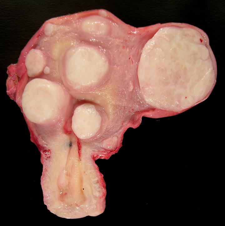 Gross appearance of a uterus with multiple leiolma/fibroid tumors (source) 