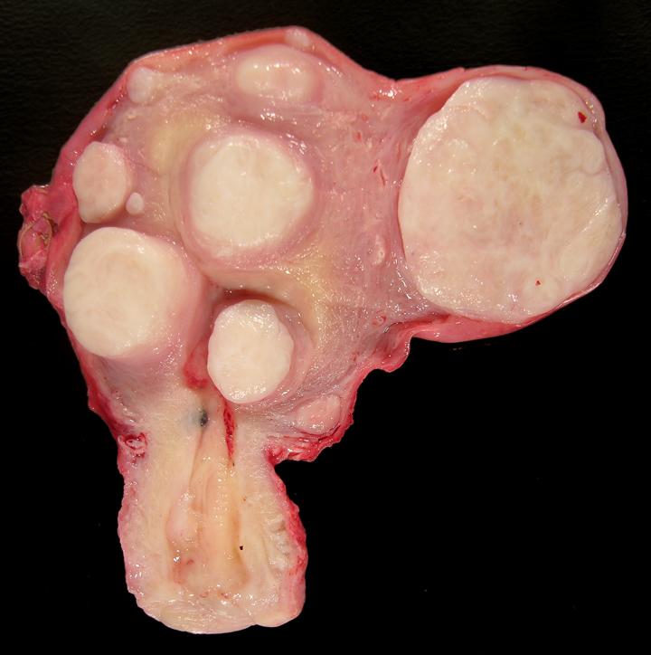 Gross appearance of a uterus with multiple leiolma/fibroid tumors (source)