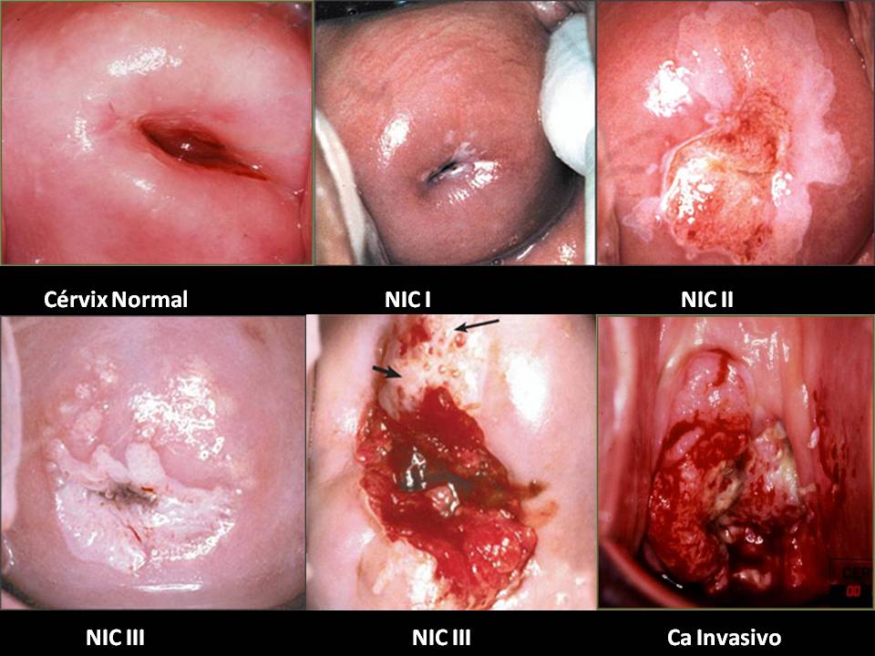 Visual appearance of different stages of cervical cancer (source) 