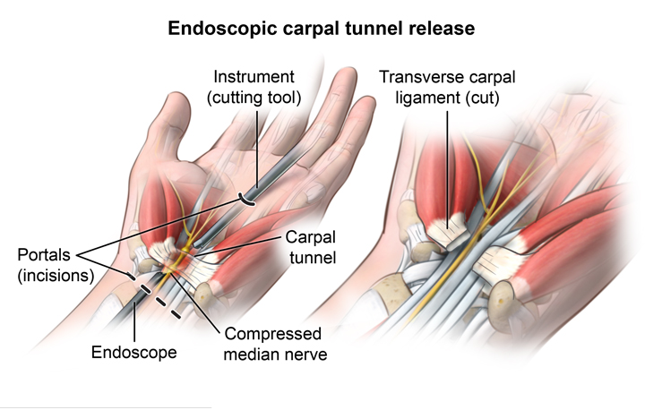 Surgical overview of carpal tunnel release (source)