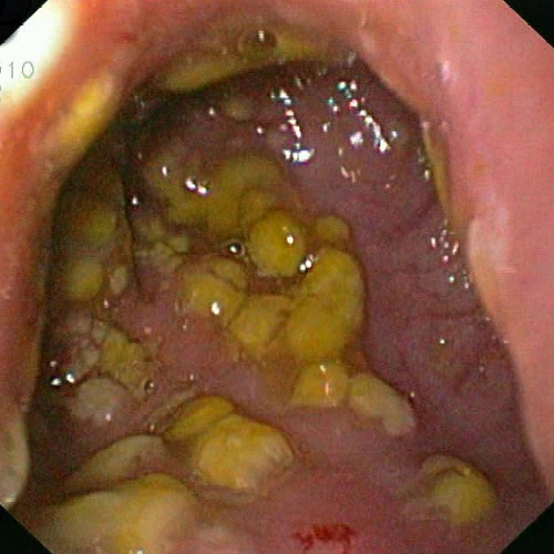 Visual appearance of pseudomembranous colitis on endoscopy (source) 