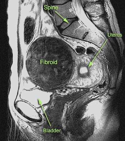 MRI imaging can show the presence of fibroids (and other pathology in the region) if a transvaginal ultrasound is not diagnostic (source) 