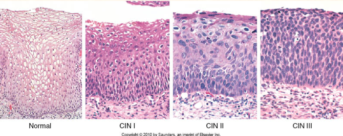 Cervical Cancer Stepwards