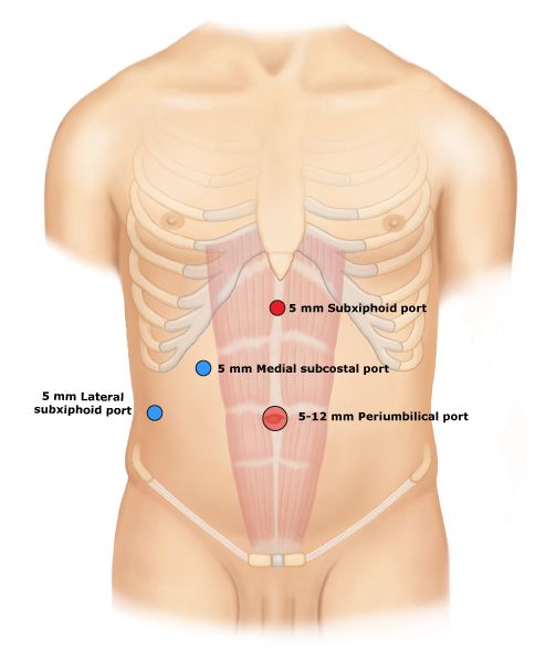 Trocar placement for laparoscopic cholecystectomy (source) 