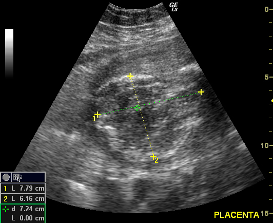 Ultrasound in a patient who has a retained placenta causing PPH (source) 