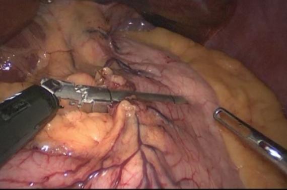 Visual appearance of the stomach through the laparoscope (source) 