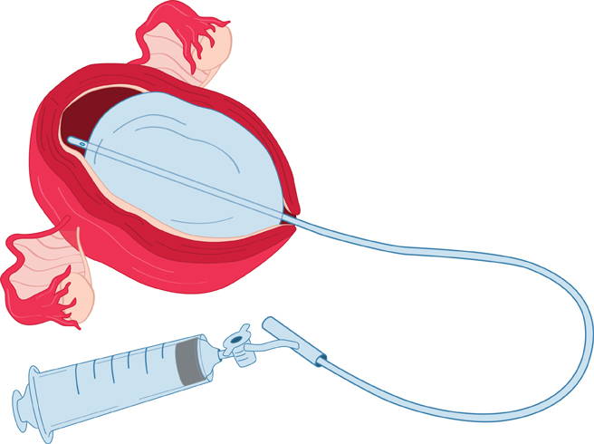 Usage of an intrauterine balloon can tamponade bleeding wishing the uterus (source)
