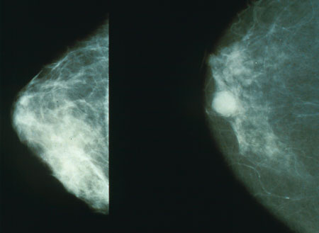 Normal breast (left) and cancerous finding (right) seen on mammography (source) 