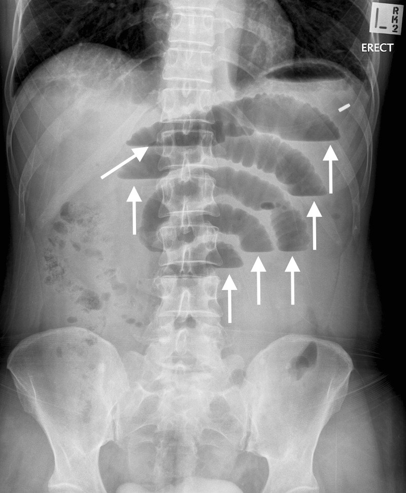 The presence of so many air fluid levels (marked by the arrows) is suspicious for an SBO (generally more then 3 is considered abnormal). These air fluid levels are seen most clearly in an upright abdominal X-ray like the one pictured above (source)