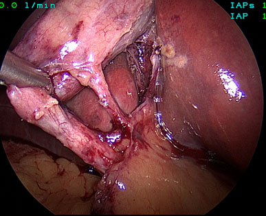 Critical view of safety in a lap chole that shows both the cystic bile duct and cystic artery entering the gall bladder (source) 