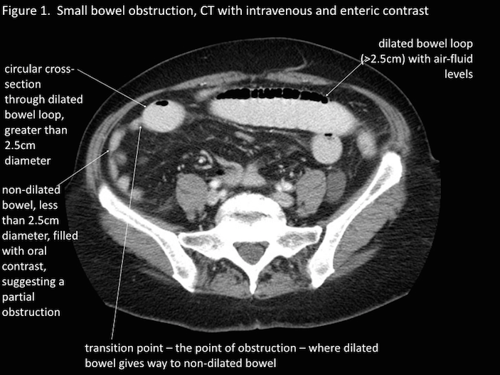 Evaluation of an SBO on a CT scan (source)