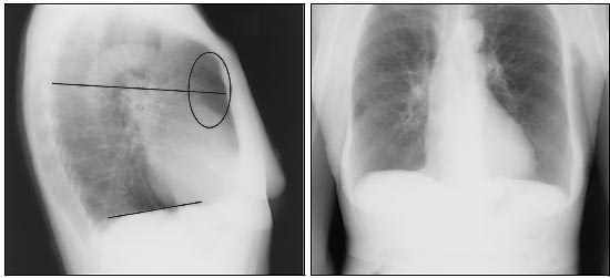 Chest x-rays of a patient with severe COPD. A flattened diaphragm can be observed (line) as well as increased retrosternal trapped air (oval, source). 