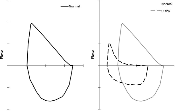 Comparison of flow vs. volume loop of a normal patient and one with COPD (source) 
