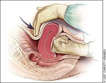 Technique of performing bimanual uterine massage (source)