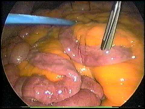In this view through the laparoscope the small bowel and omentum can be seen (source) 