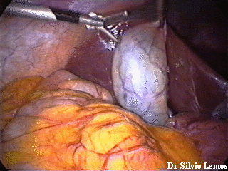 In this iamge the gall baldder is grasped and raised. The Liver can be seen at the top right of the image, and bowel/omentum can be appreciated towards the bottom of the image. 