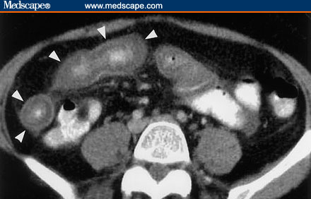 Bowel wall thickening seen in a patient with small bowel ischemia (source)