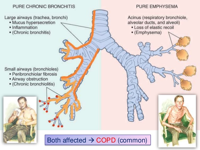 Comparison between subtypes of COPD: chronic bronchitis and emphysema (source).