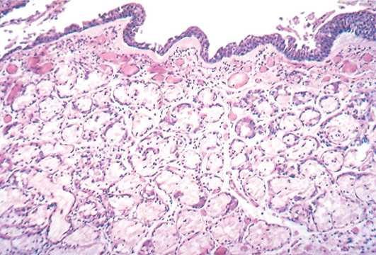 Increased size of mucus glands in the submucosa in this patient with chronic bronchitis can be appreciated histologically (source) 
