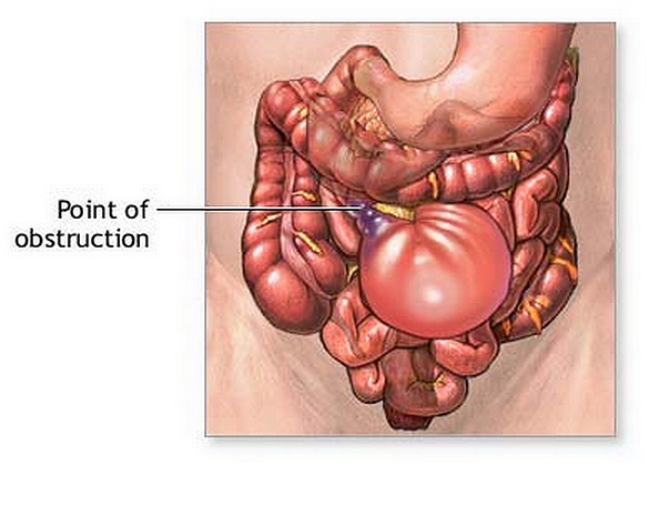 It is important not to overcomplicate the topic of an SBO! Its name is very self-descriptive (source)