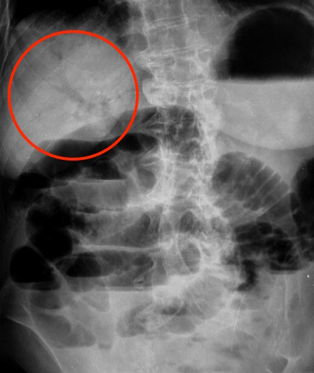 Translucency over the hepatic shadows seen over this radiograph is suggestive of portal venous gas (source) 