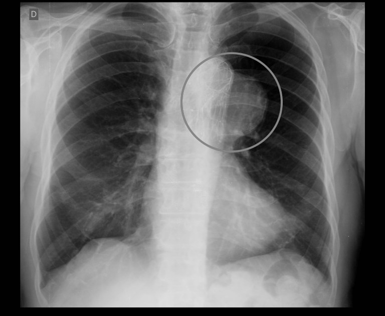 Aneurysm of the thoracic aorta on a chest X-ray (source)