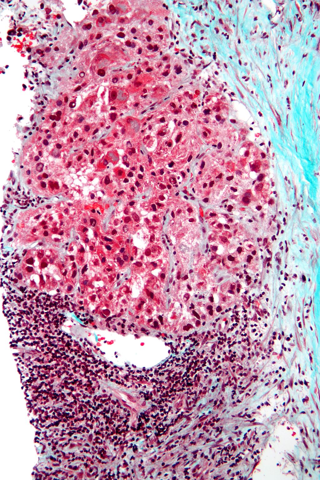 Biopsy of a HCC prepared with a trichrome stain (source)