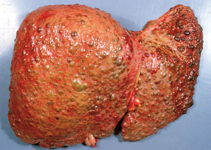Diseased organ in Wilson disease (source)