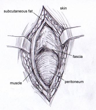Layers of tissues between the skin and peritoneum (source) 