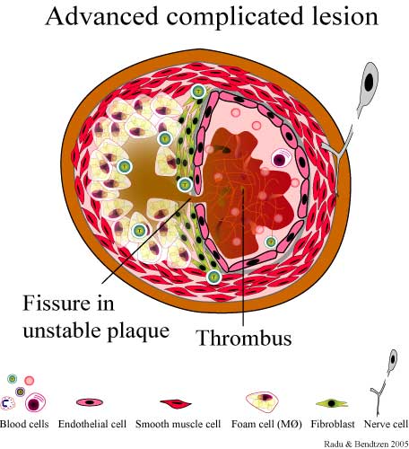 Rupture of an atherosclerotic plaque can lead to thrombus formation (shown above) that can occlude the coronary artery. This will cause ischemia (source) 