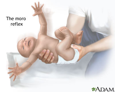 Appearance of baby during the Moro reflex test (source)