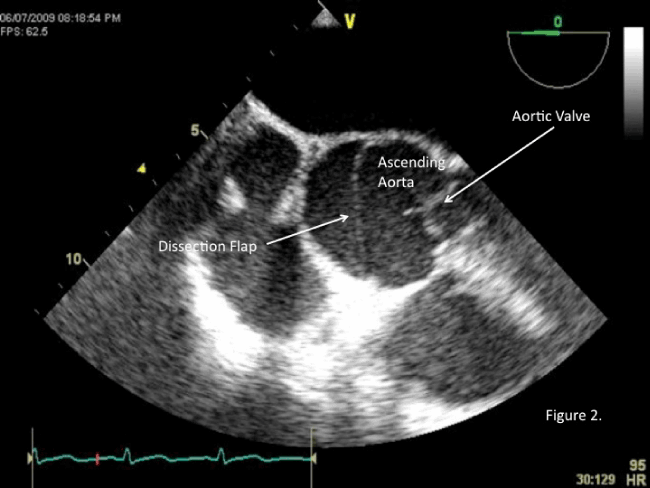 Presence of aortic dissection flap on echo (source) 