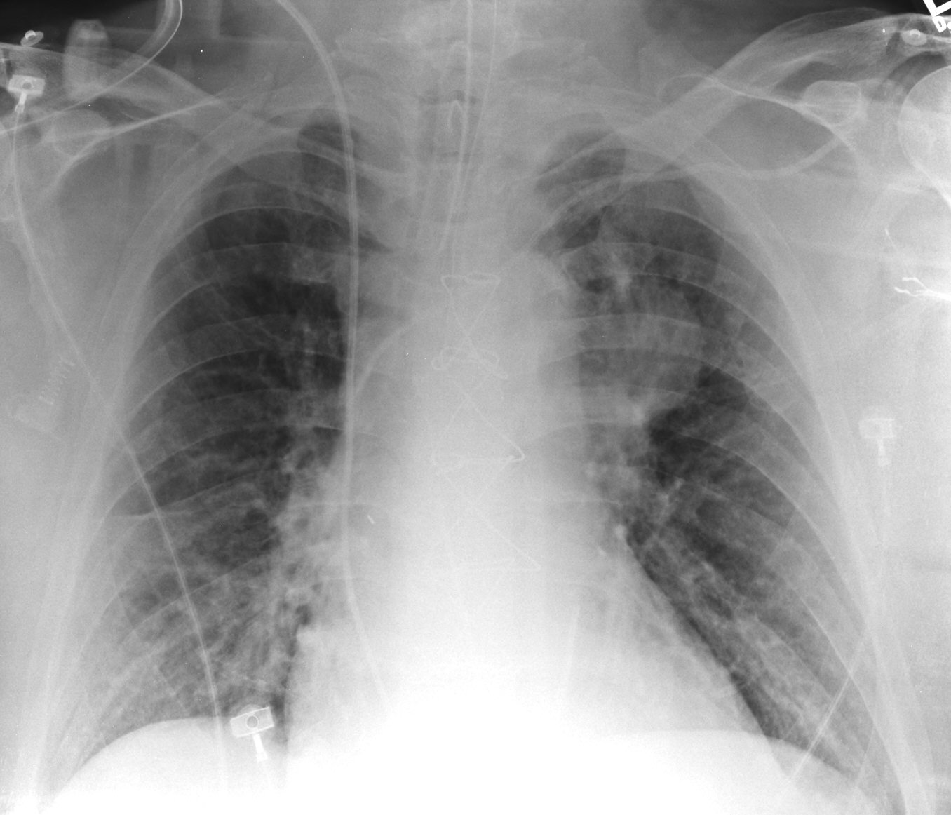 A widened mediastinum is seen here on the chest X-ray in a patient with a thoracic aortic aneurysm (source)