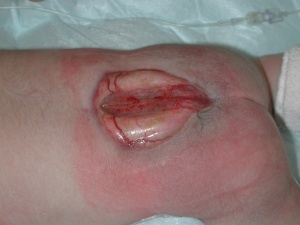 Spina bifida in a newborn (source)