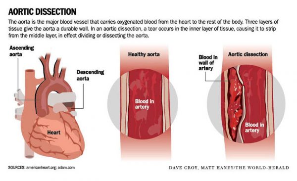 aortic-dissection-stepwards