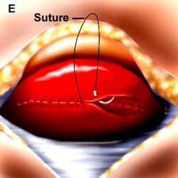 Visual appearance of uterus during second layer of closure. Running locked first layer visualized below second layer simple running suture (source). 