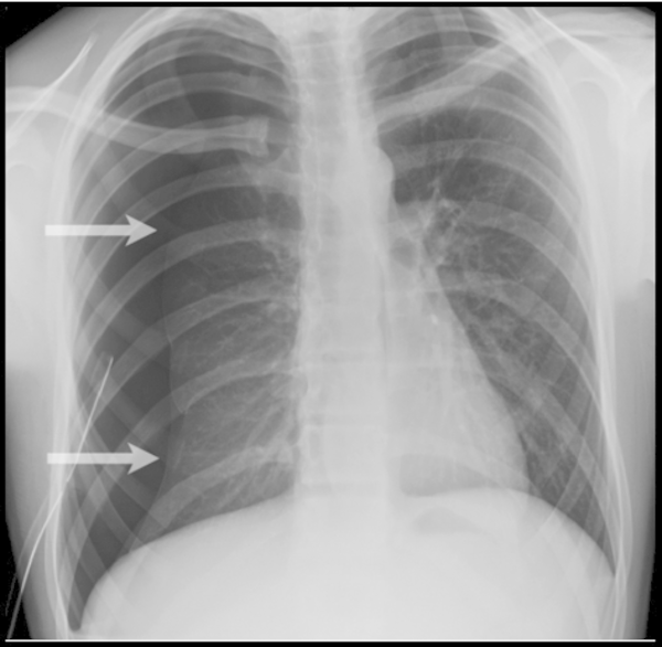 Right sided pneumothorax on a chest X-ray. White arrows pain to the pleural line marking the border of the right lung (source) 