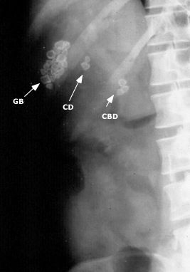 Visualization of gallstones on a KUB. (source). They appear in the gall bladder (GB), cystic duct (CD), and common bile duct (CBD). 