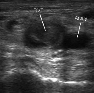 Detection of DVT on ultrasound (source) 