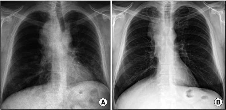 In pane A a large mass around the trachea has caused significant deviation. In page B this issue has been resolved and the trachea is midline. 