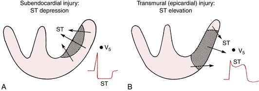 Types of MI and associated EKG findings (source) 