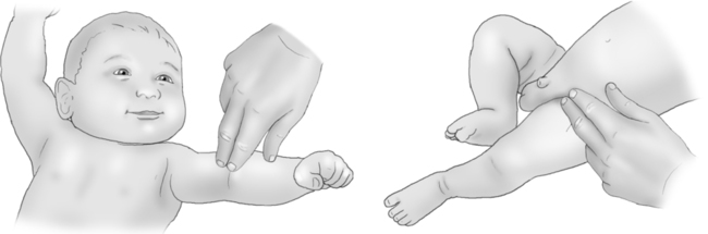 Location of brachial and femoral pulses in a newborn (source) 