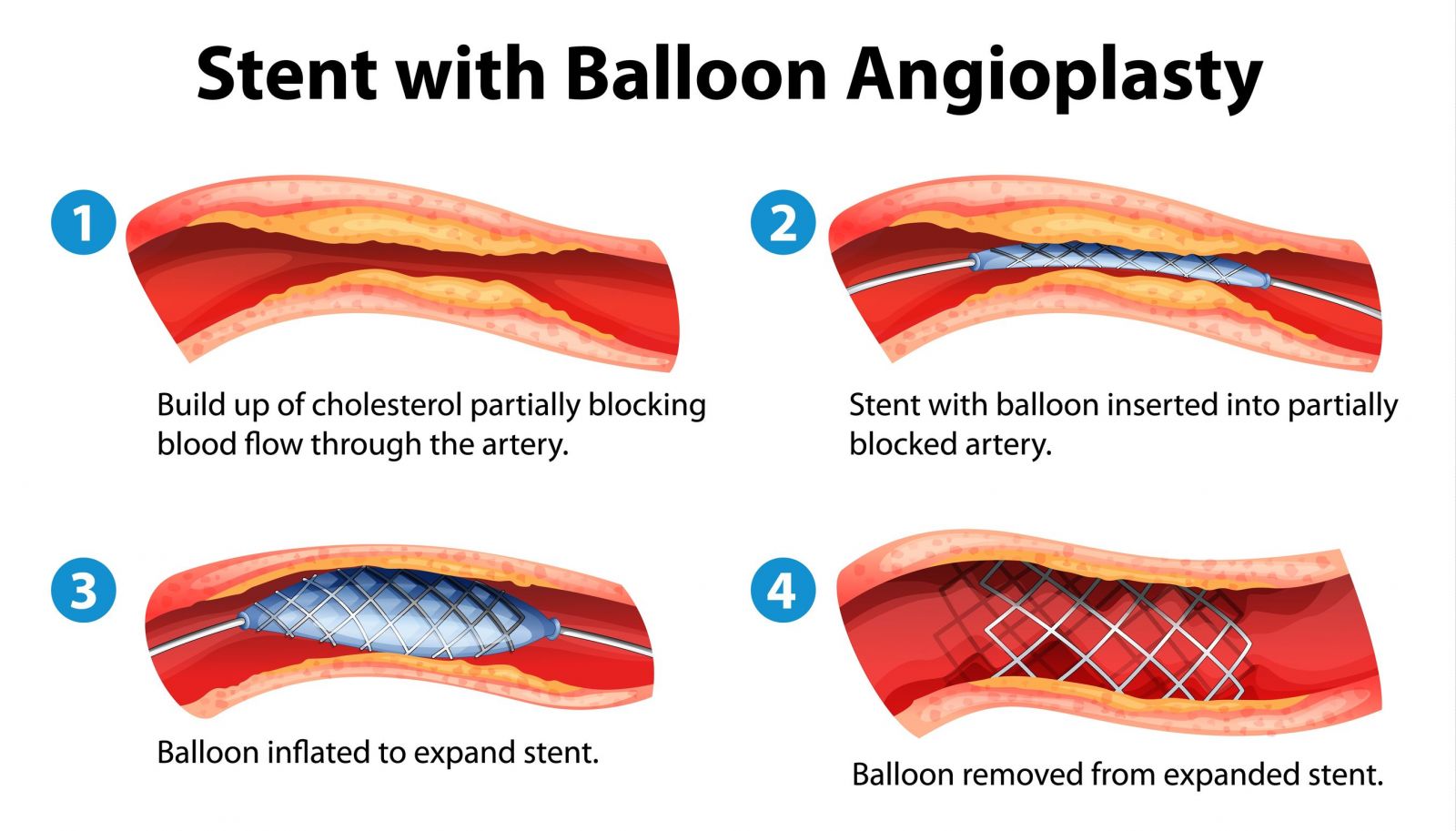 Basic steps in balloon angioplasty with stenting (source) 
