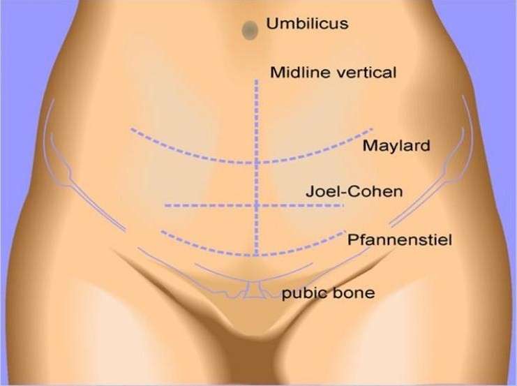 Different types of initial skin incisions that can be performed for a cesarean delivery (source) 